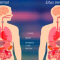 situs inversus u órganos invertidos