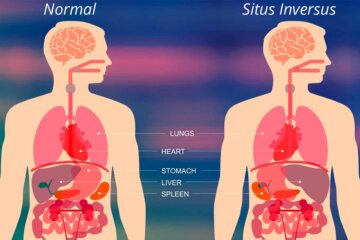 situs inversus u órganos invertidos