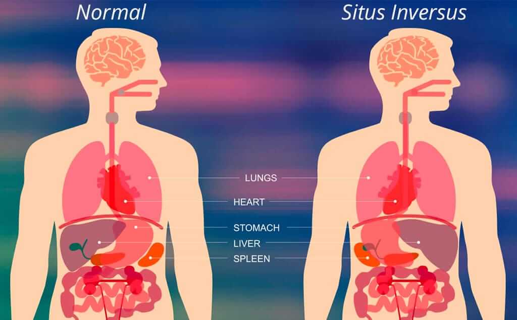 situs inversus u órganos invertidos