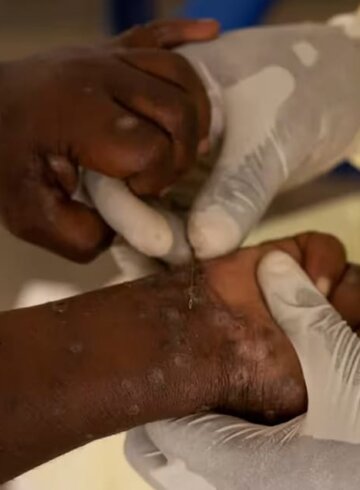 MPOX en Congo