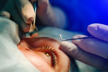 transplante de cornea