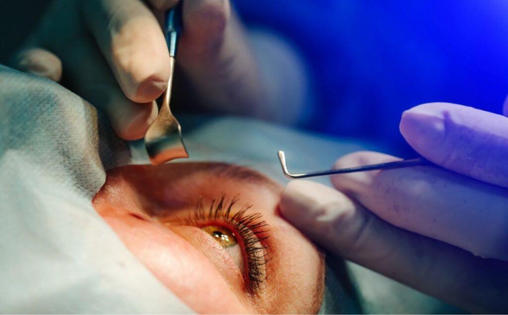 transplante de cornea