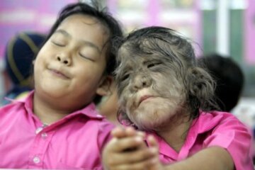 sindrome del hombre lobo en niños