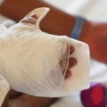 niños quemados con polvora